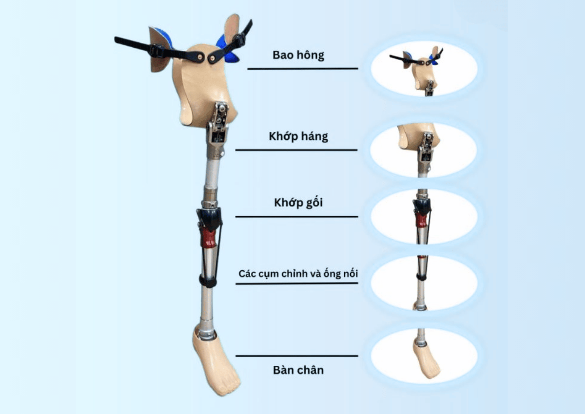 Cấu tạo của chân giả tháo khớp háng